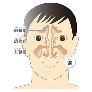 蓄のう症・副鼻腔炎